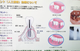 インプラント